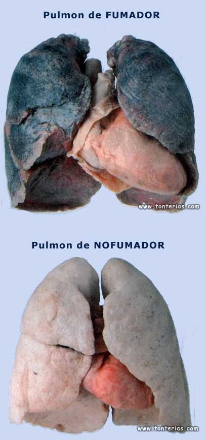 Pulmones tabaco
